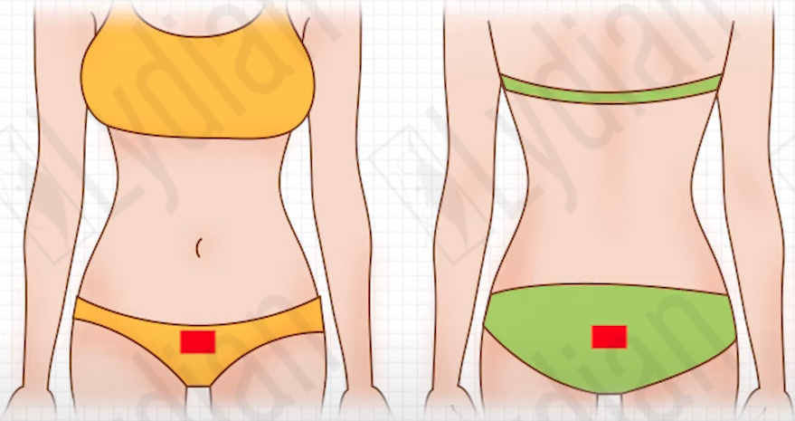 abdomenen liposuction scar