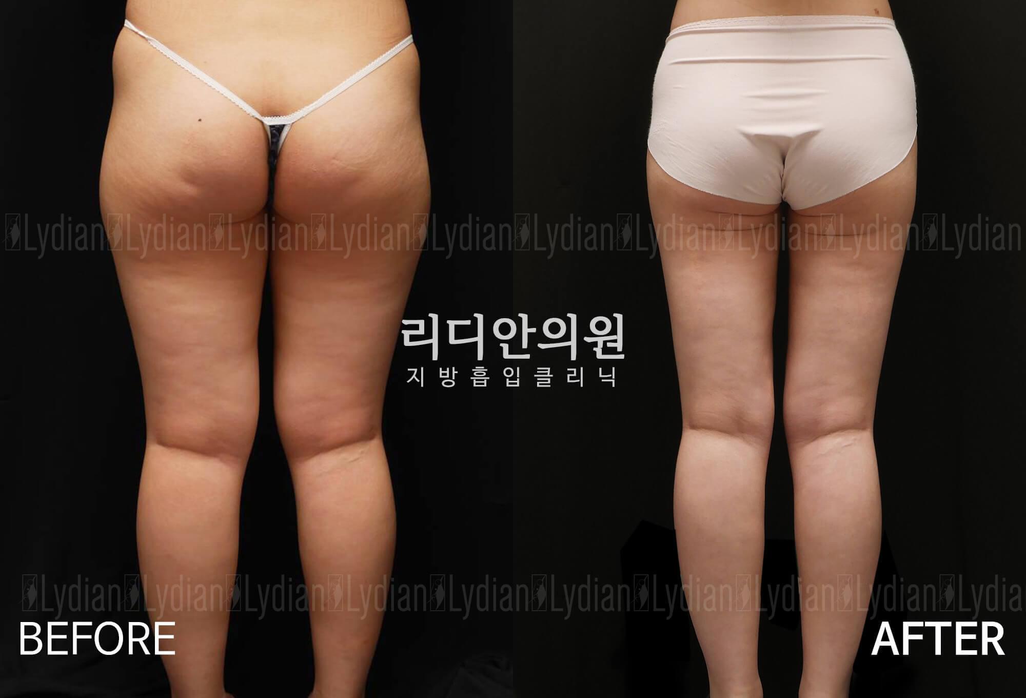 liposuction before after pictures korea
