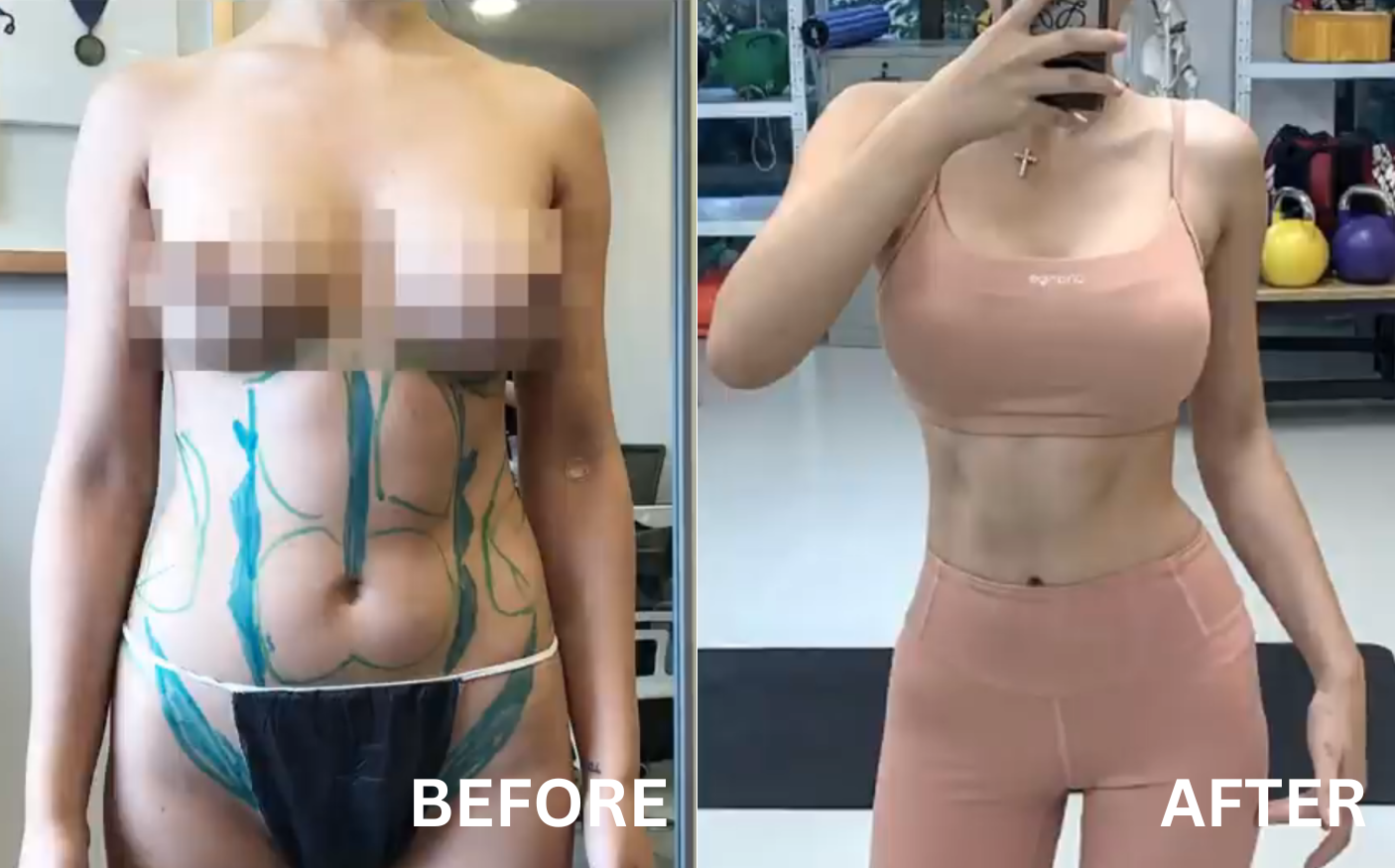 before after pictures liposuction