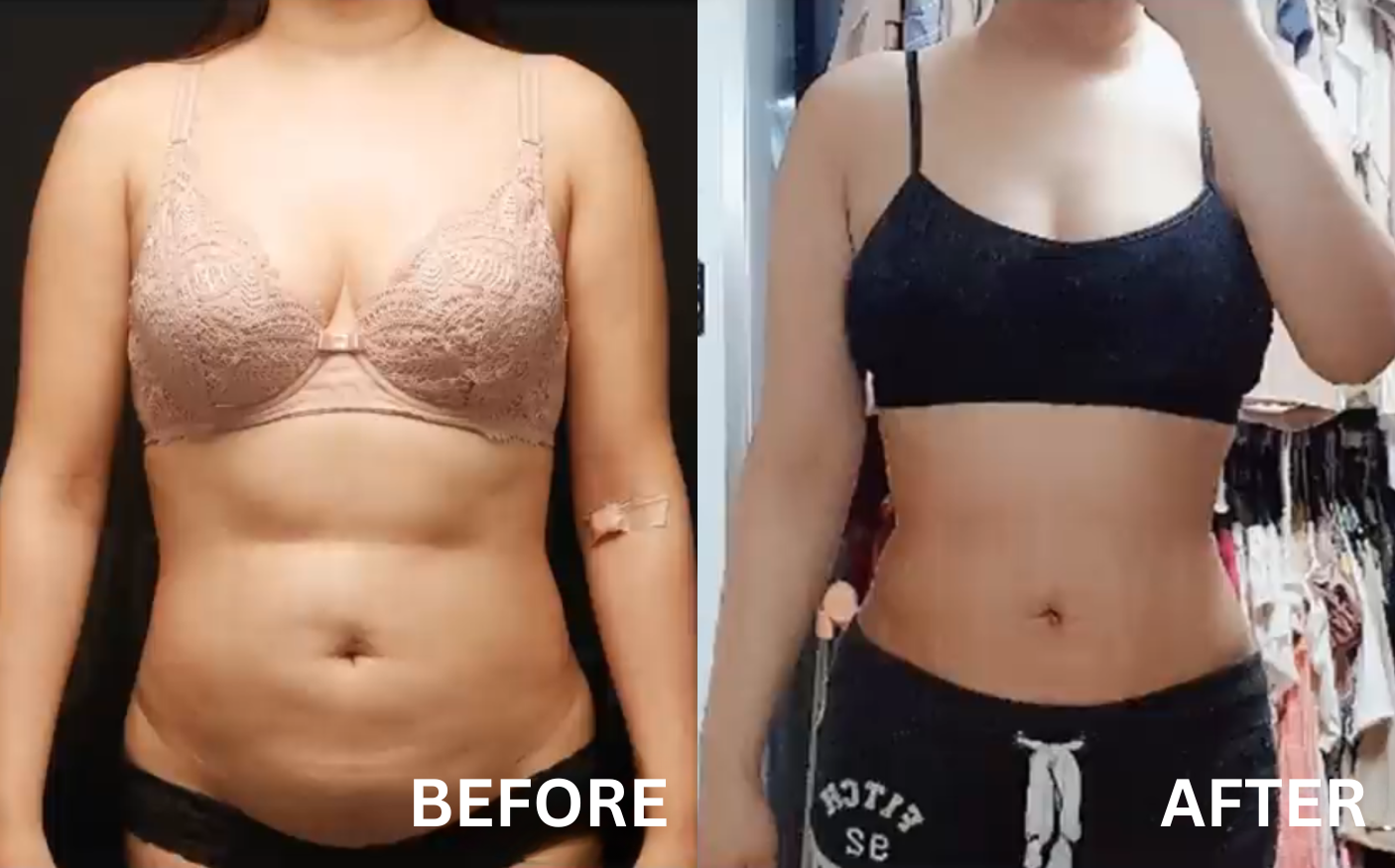 before after pictures liposuction