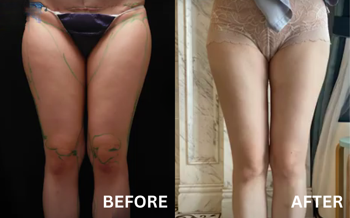 before after pictures liposuction