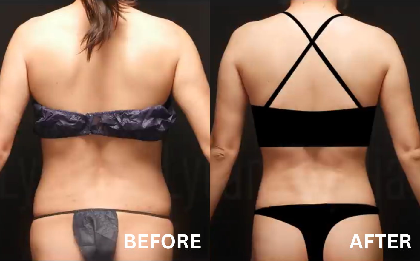 before after pictures liposuction