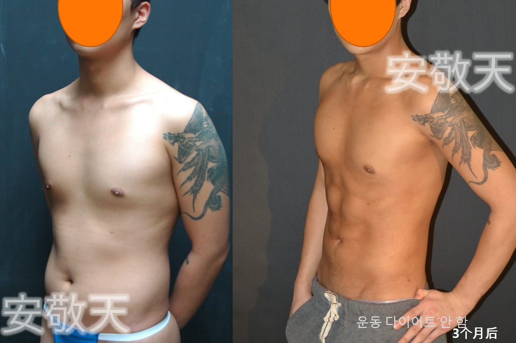 5D liposulpture korea before after image