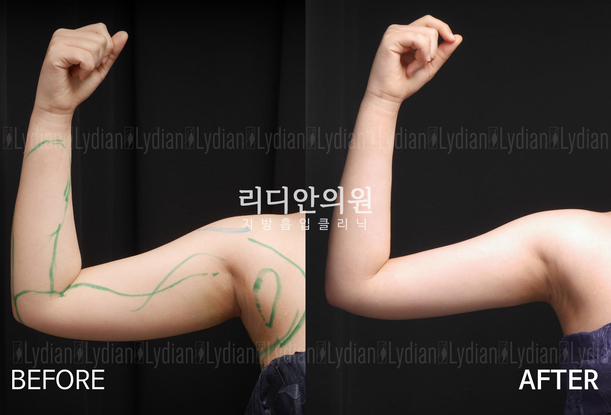 liposuction before after pictures korea