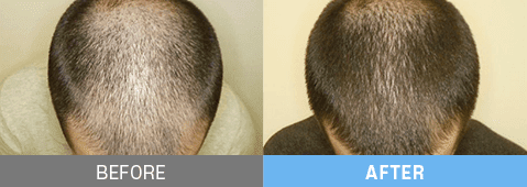 stem cell therapy korea before after