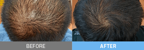 stem cell therapy korea before after