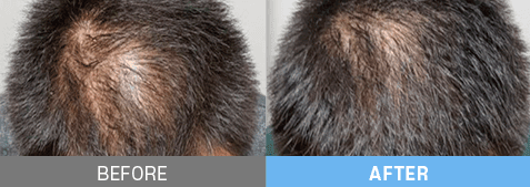 stem cell therapy korea before after
