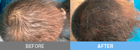 stem cell therapy korea before after