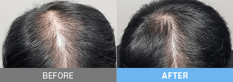 stem cell therapy korea before after