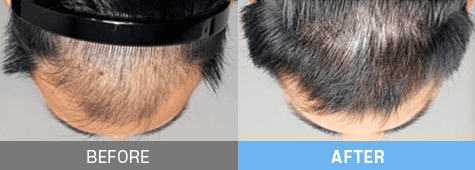 stem cell therapy korea before after