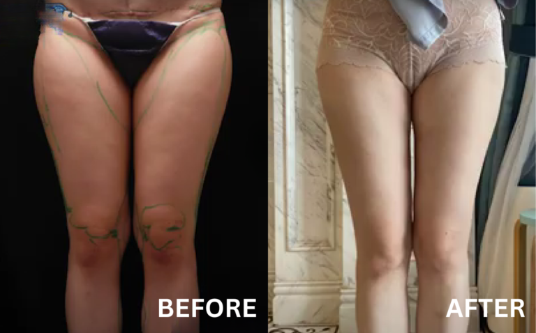 before after pictures liposuction korea