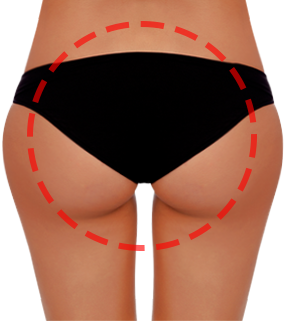 brazilian butt lift korea