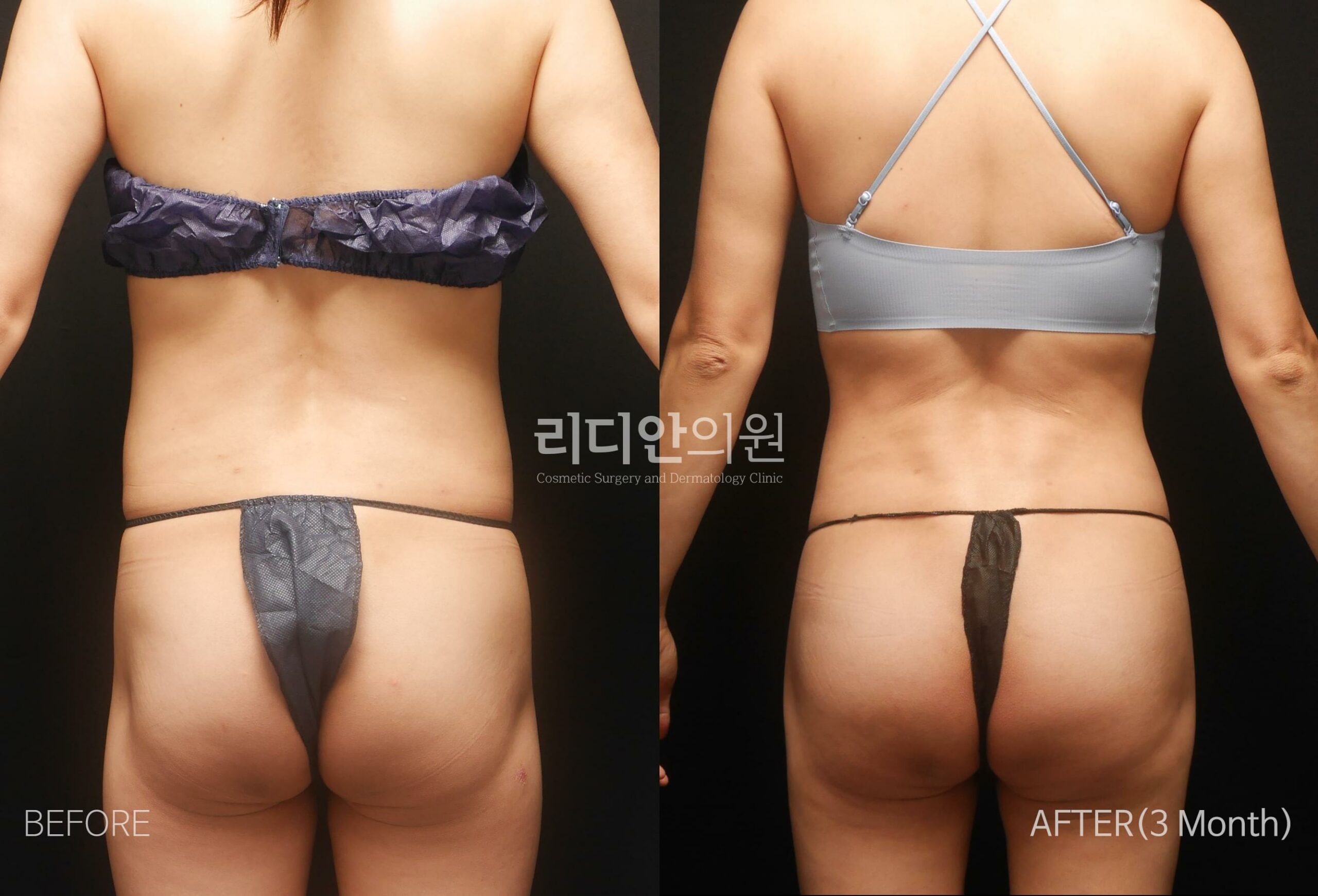 stem cell fat grafting korea before after
