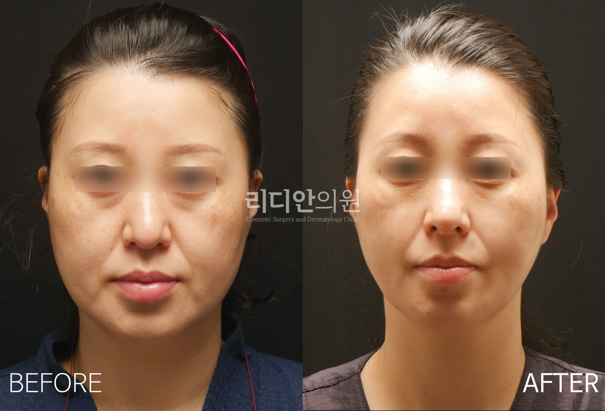 stem cell fat grafting korea before after