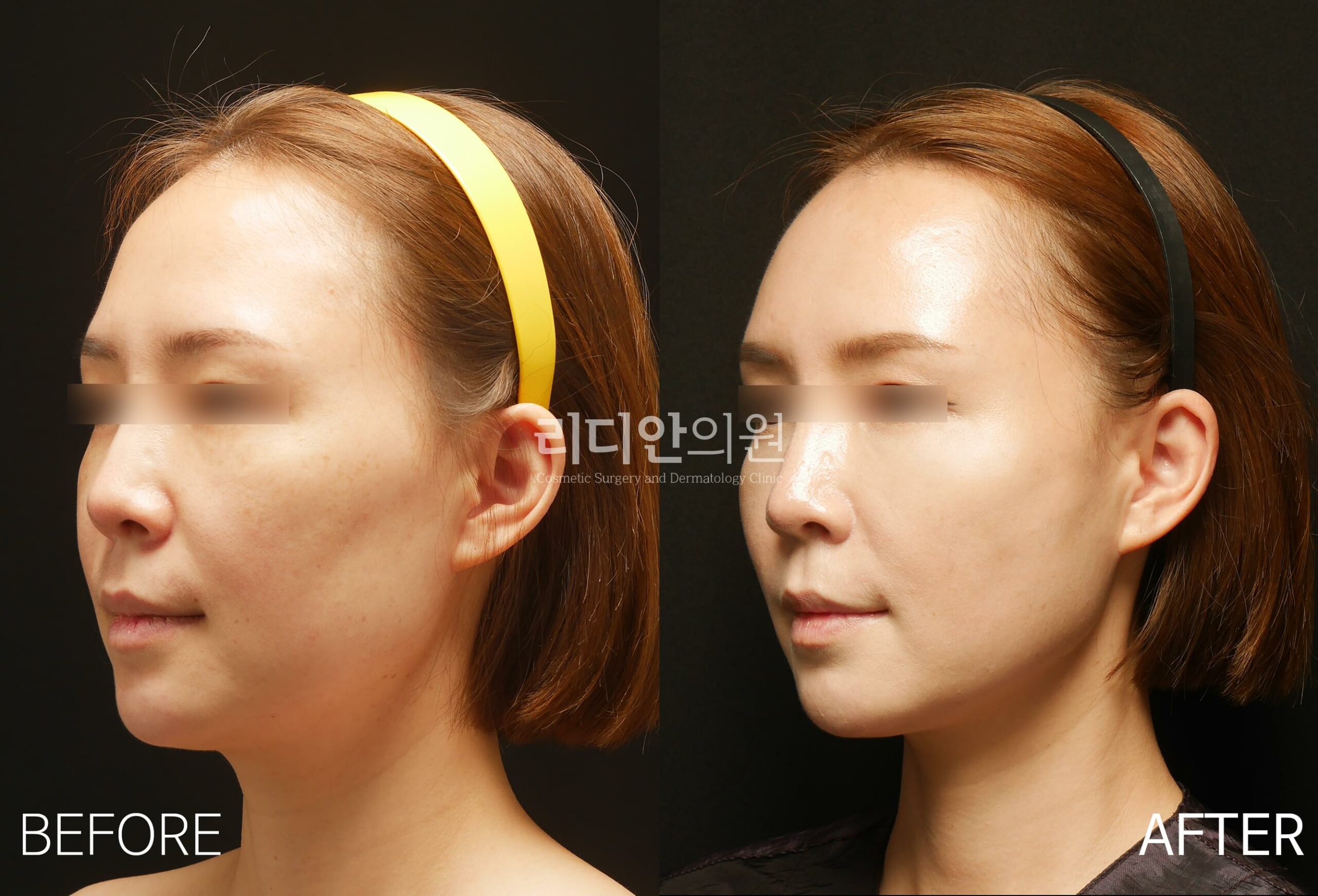 stem cell fat grafting korea before after