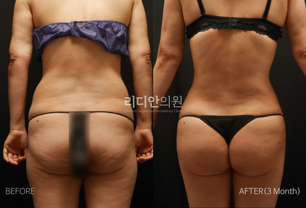 stem cell therapy korea before after