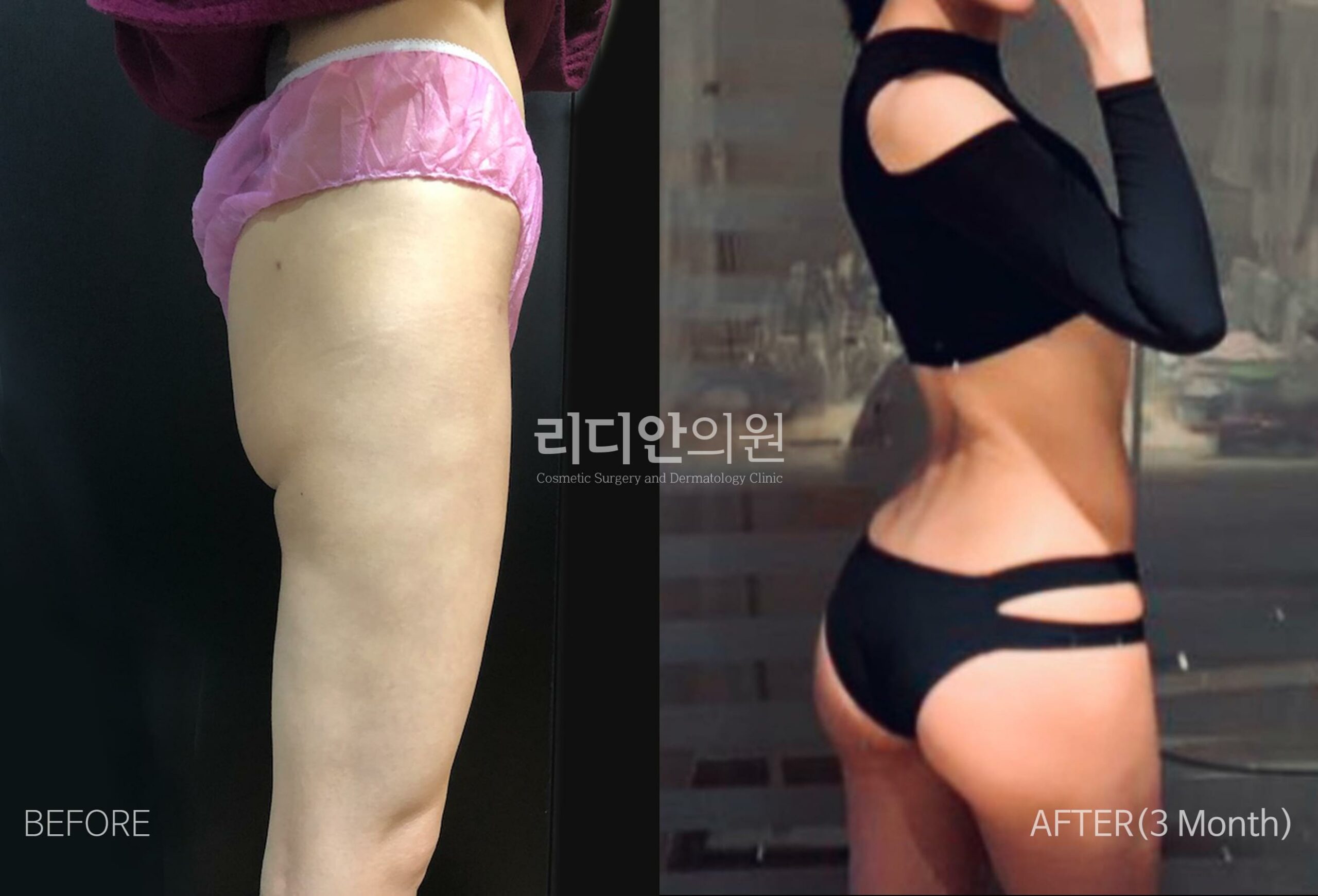 stem cell fat grafting korea before after