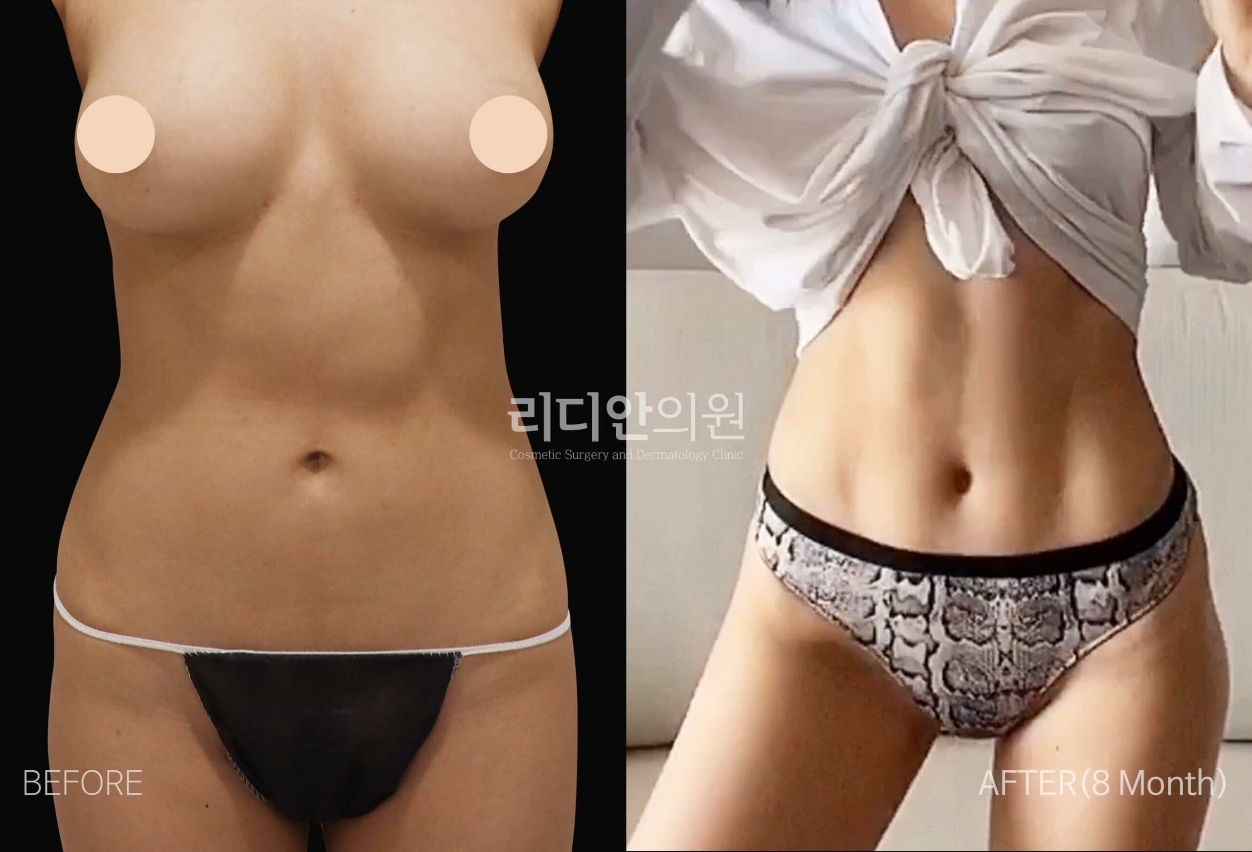 5D liposulpture korea before after image