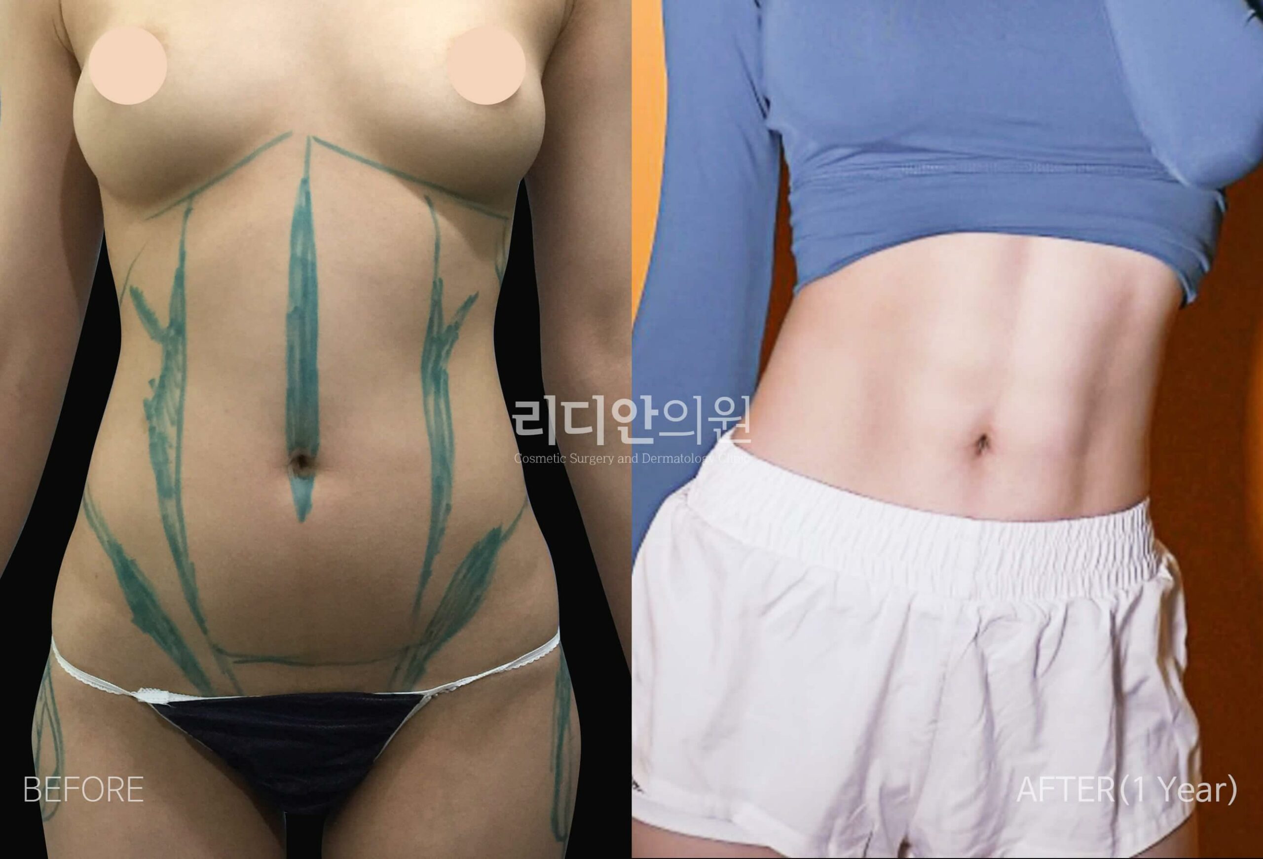 5D liposulpture korea before after image