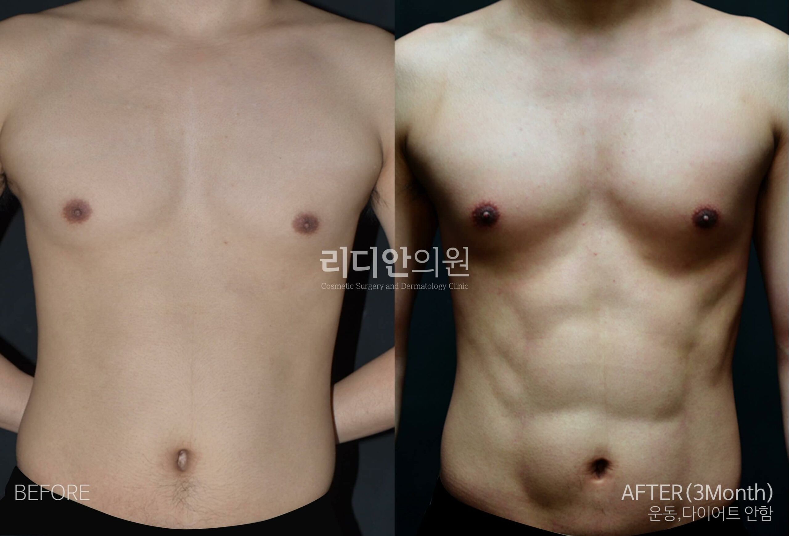 5D liposulpture korea before after image