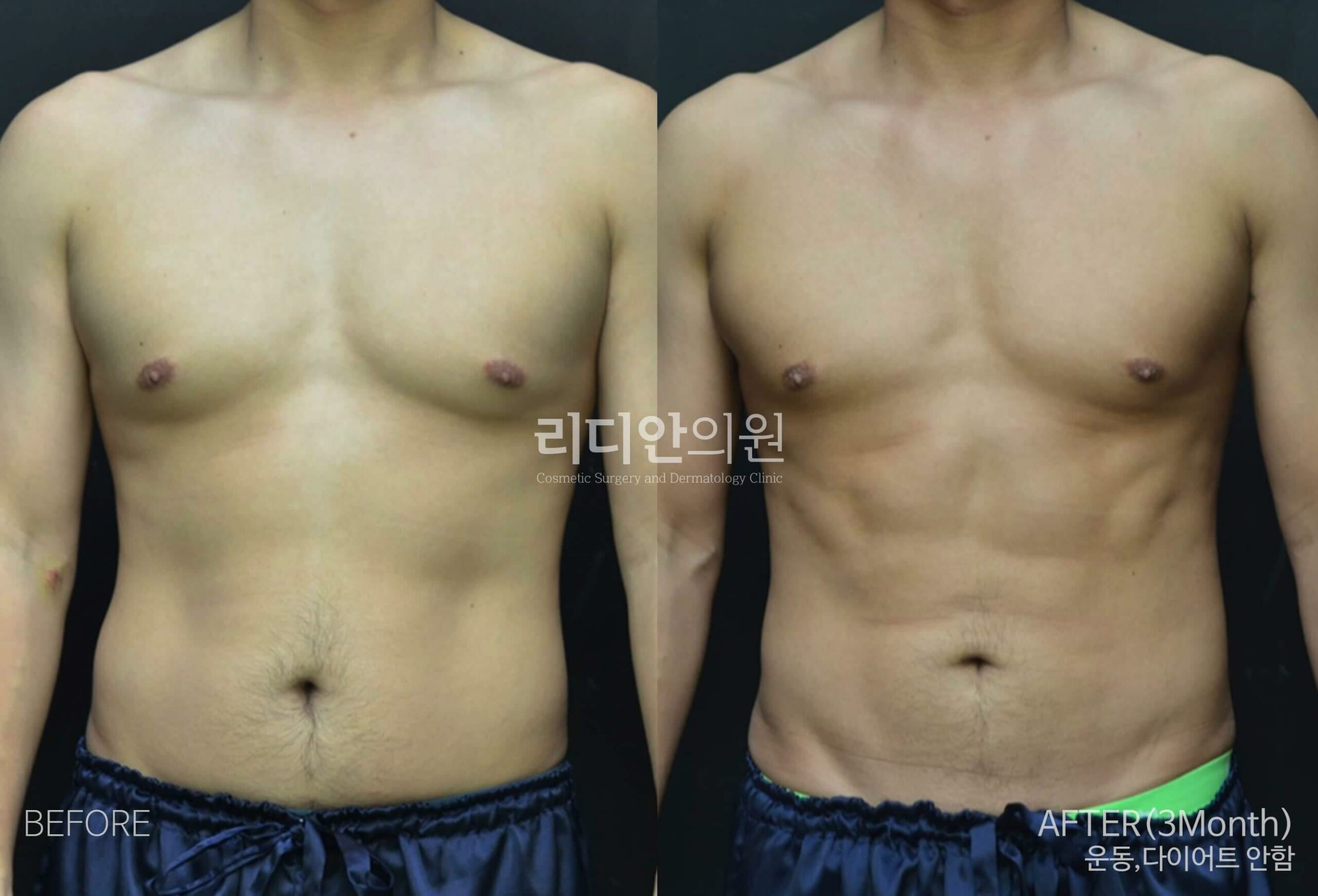 5D liposulpture korea before after image
