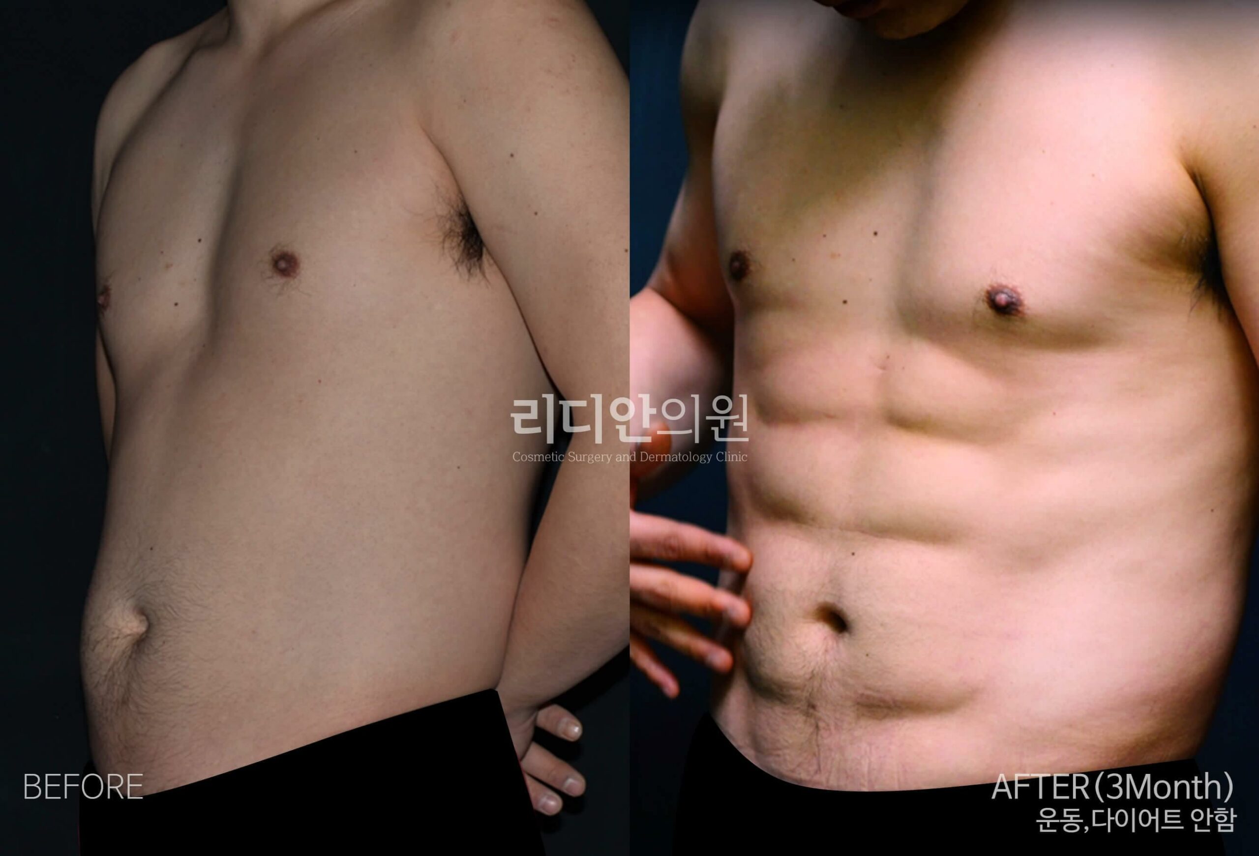 5D liposulpture korea before after image