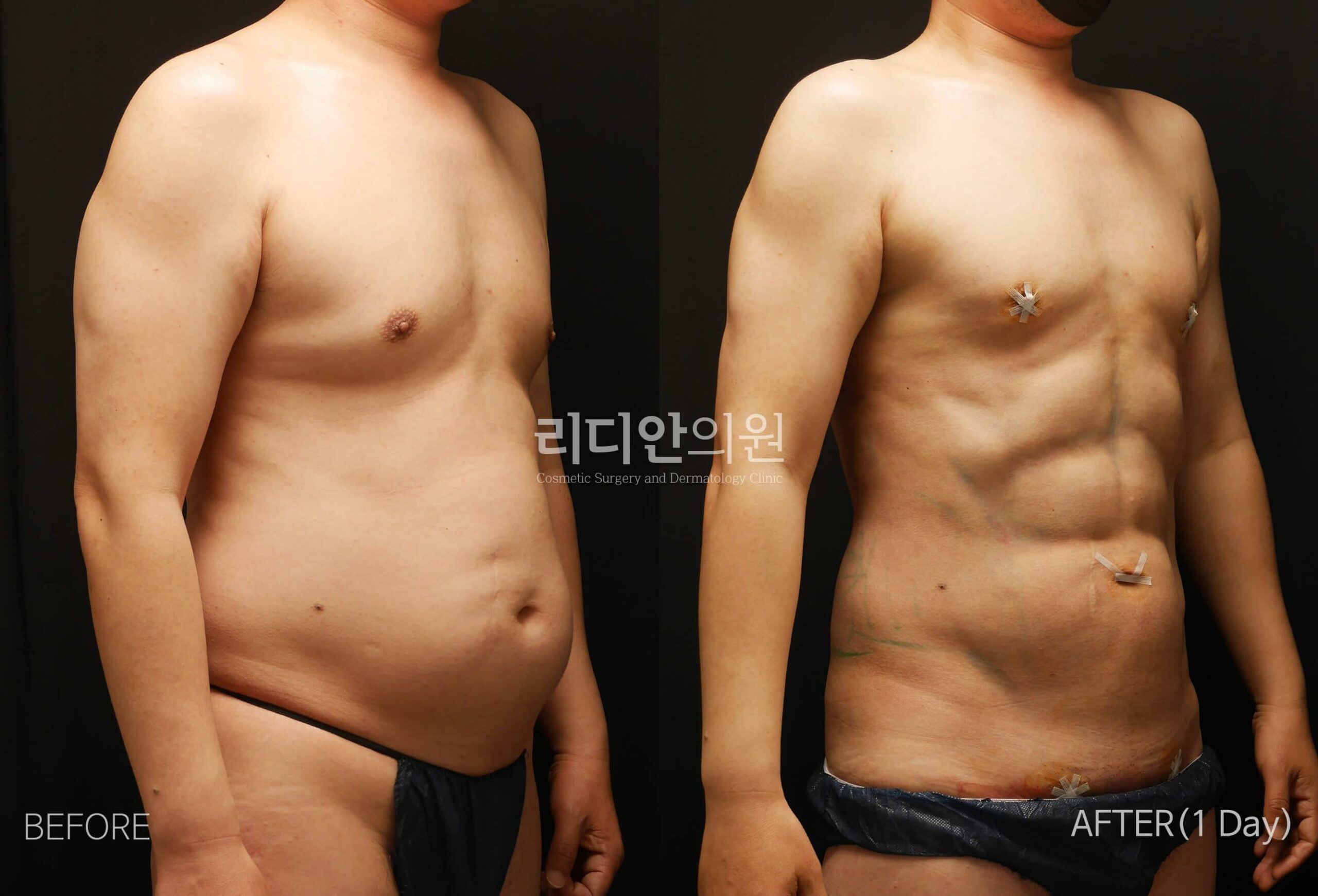 5D liposulpture korea before after image
