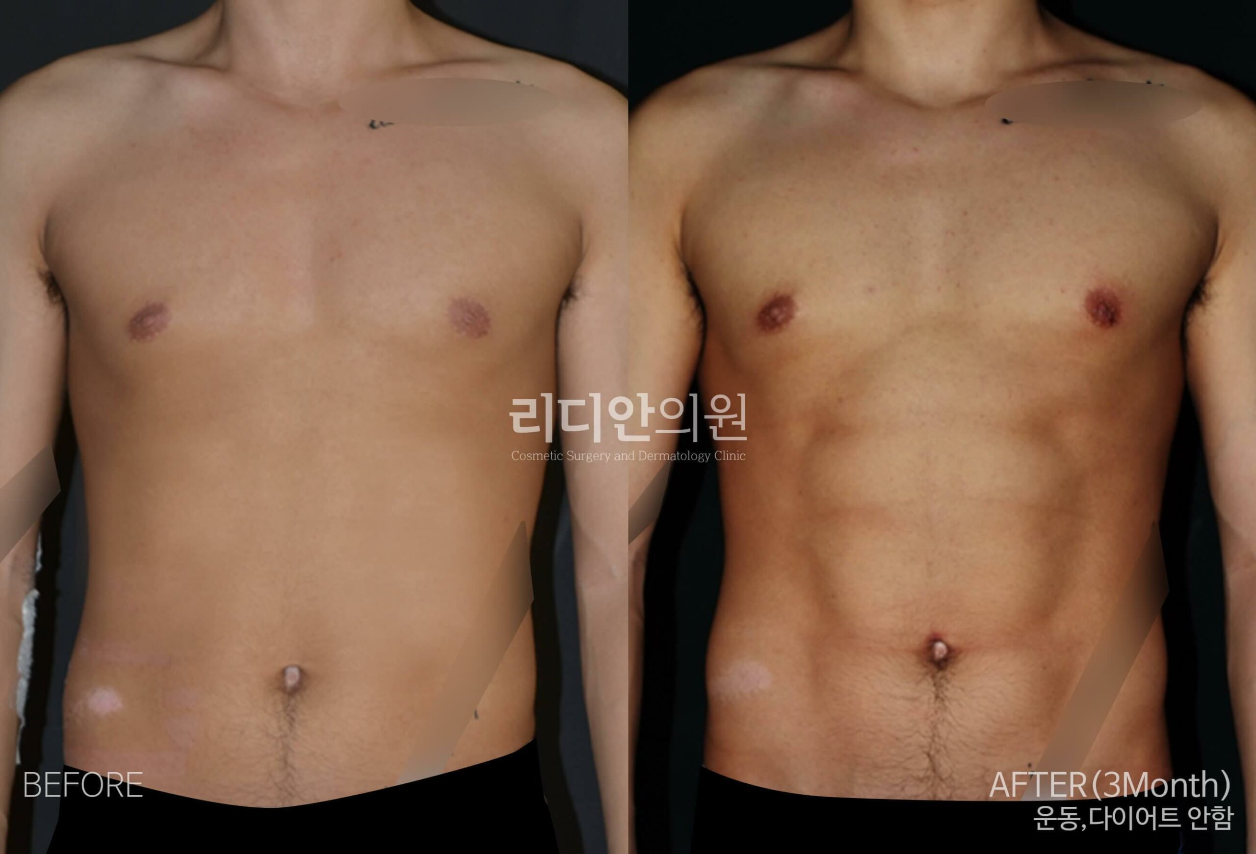 5D liposulpture korea before after image