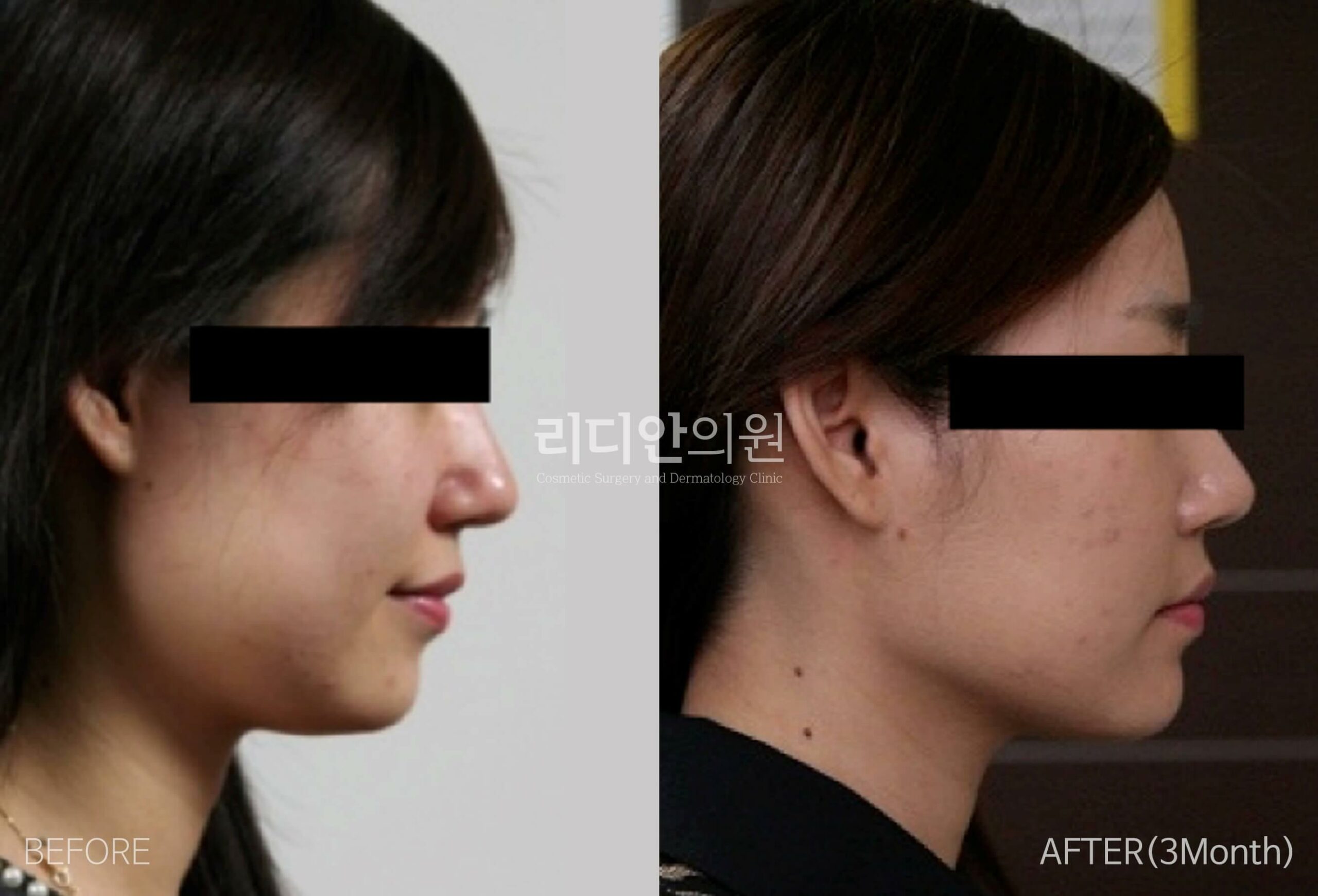 liposuction before after pictures korea