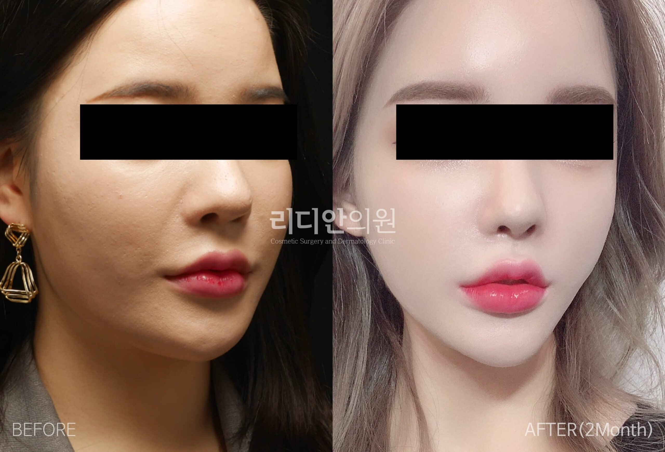liposuction before after pictures korea