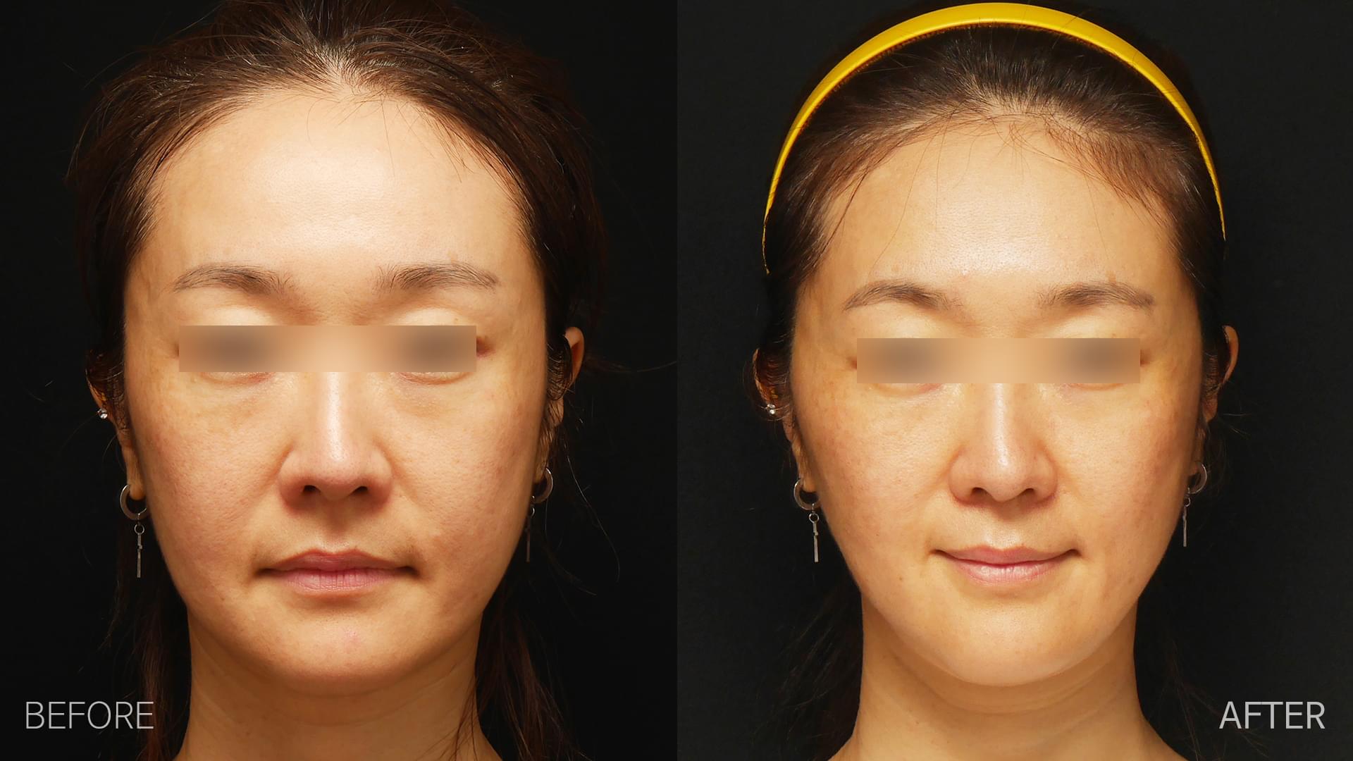 facelift korea before after pictures