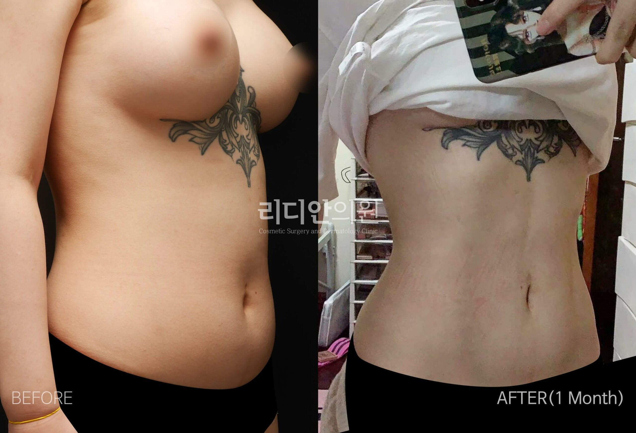 liposuction before after pictures korea