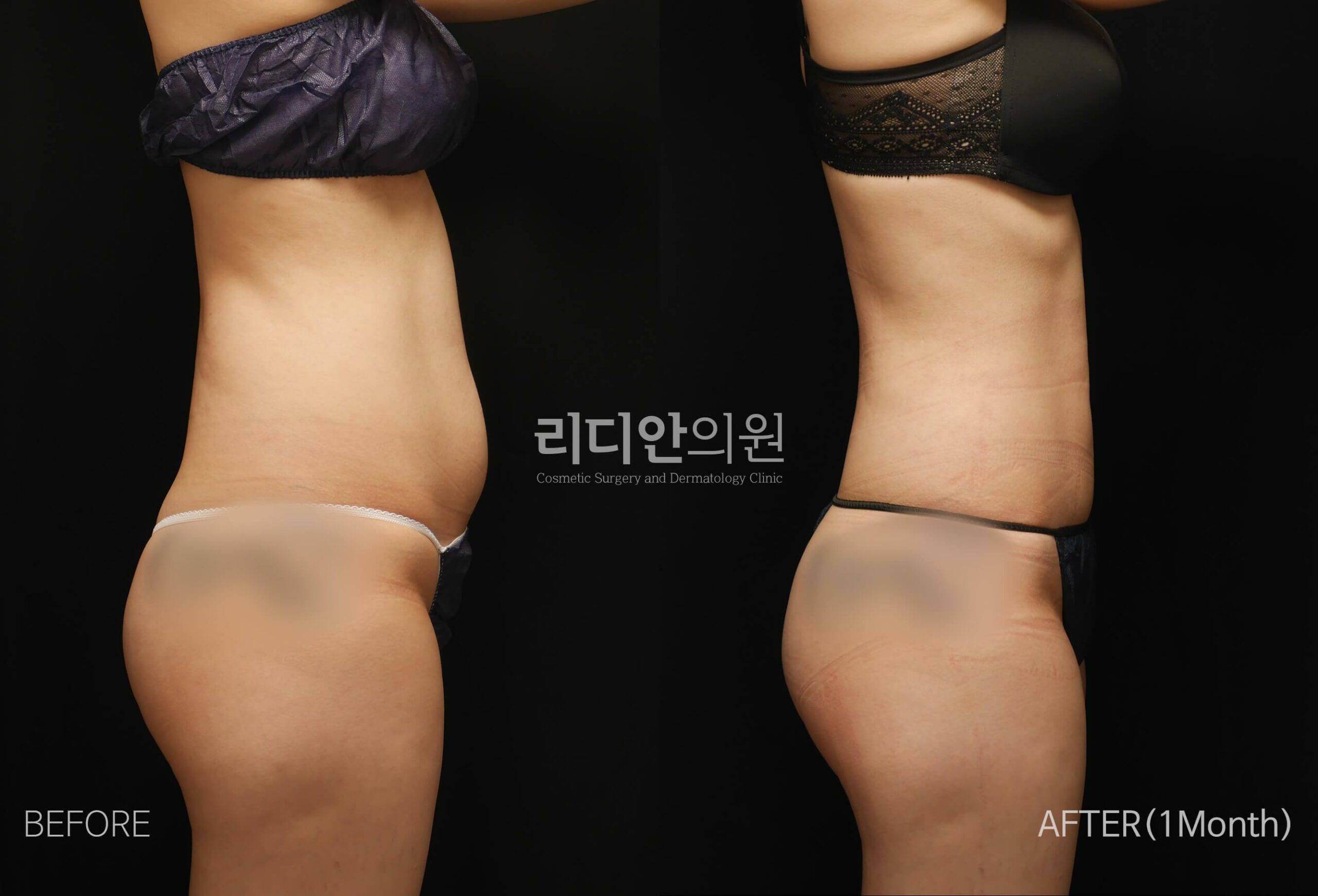 liposuction before after pictures korea