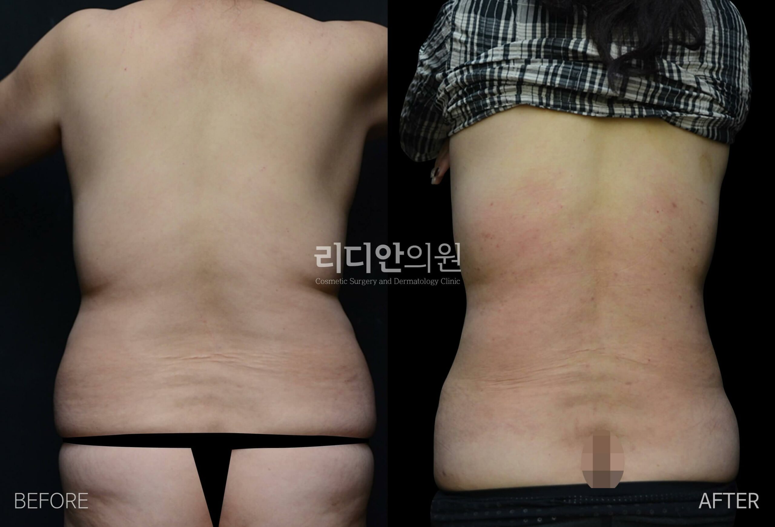 liposuction before after pictures korea