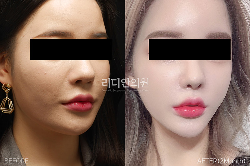 stem cell therapy korea before after