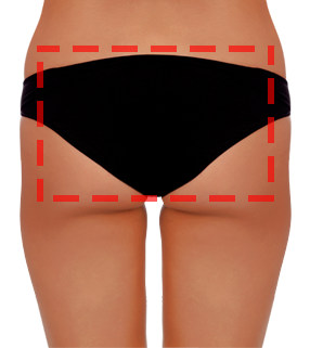 brazilian butt lift korea