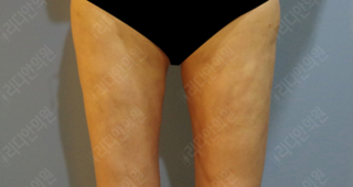 revision liposuction korea