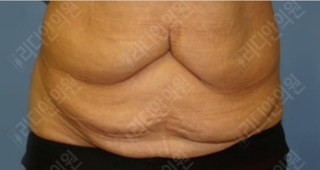 revision liposuction korea