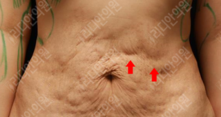 revision liposuction korea