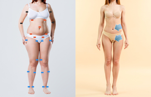 body sculpting 5D liposculpture korea