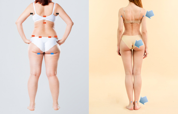 body sculpting 5D liposculpture korea