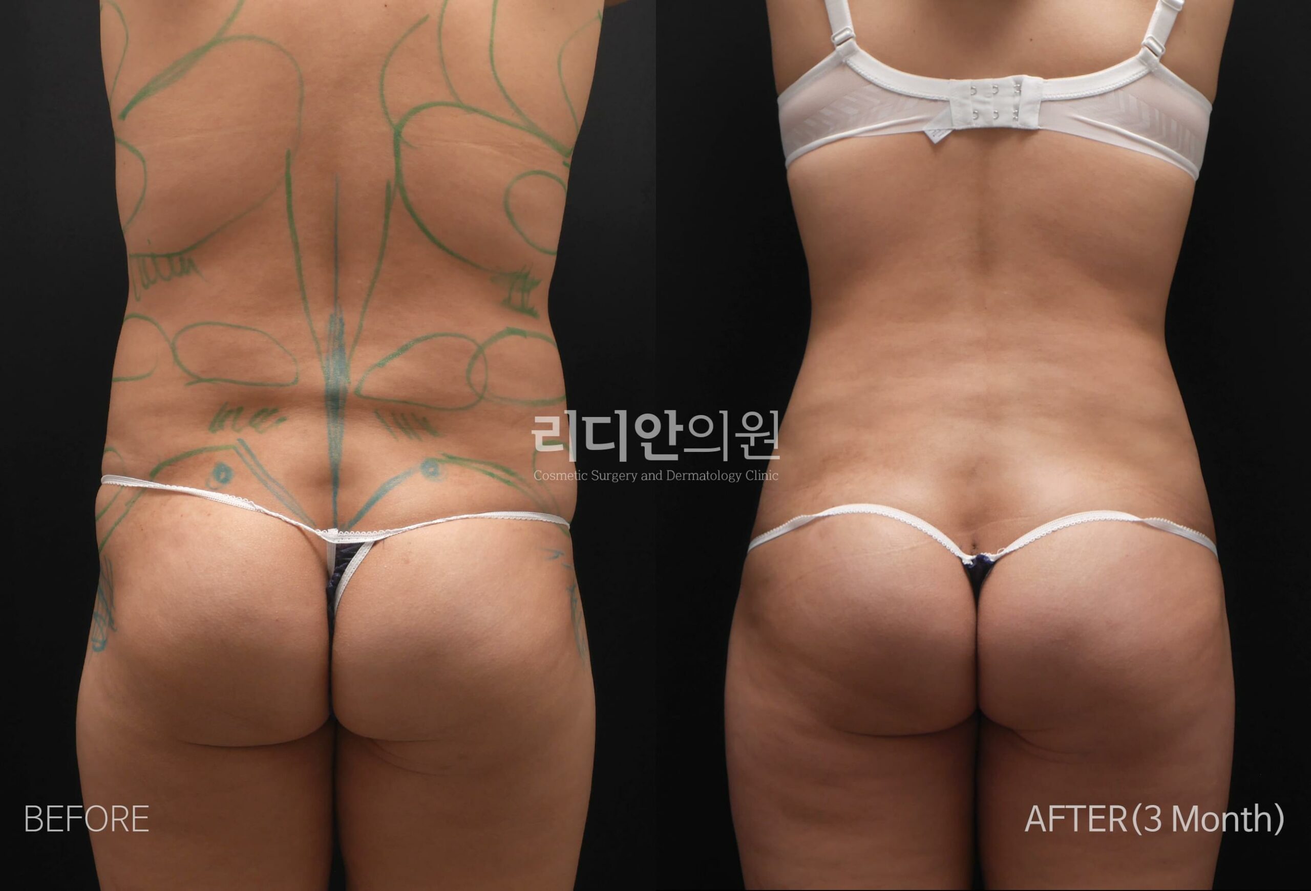 brazilian butt lift bbl before after pictures korea