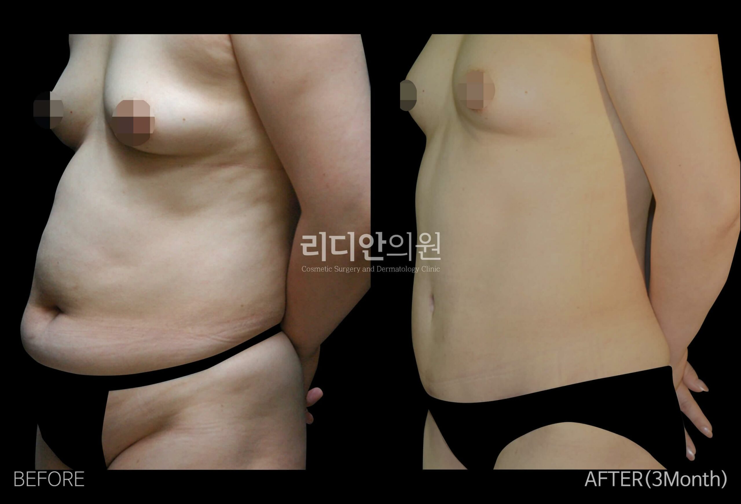 tummy tuck korea before after pictures