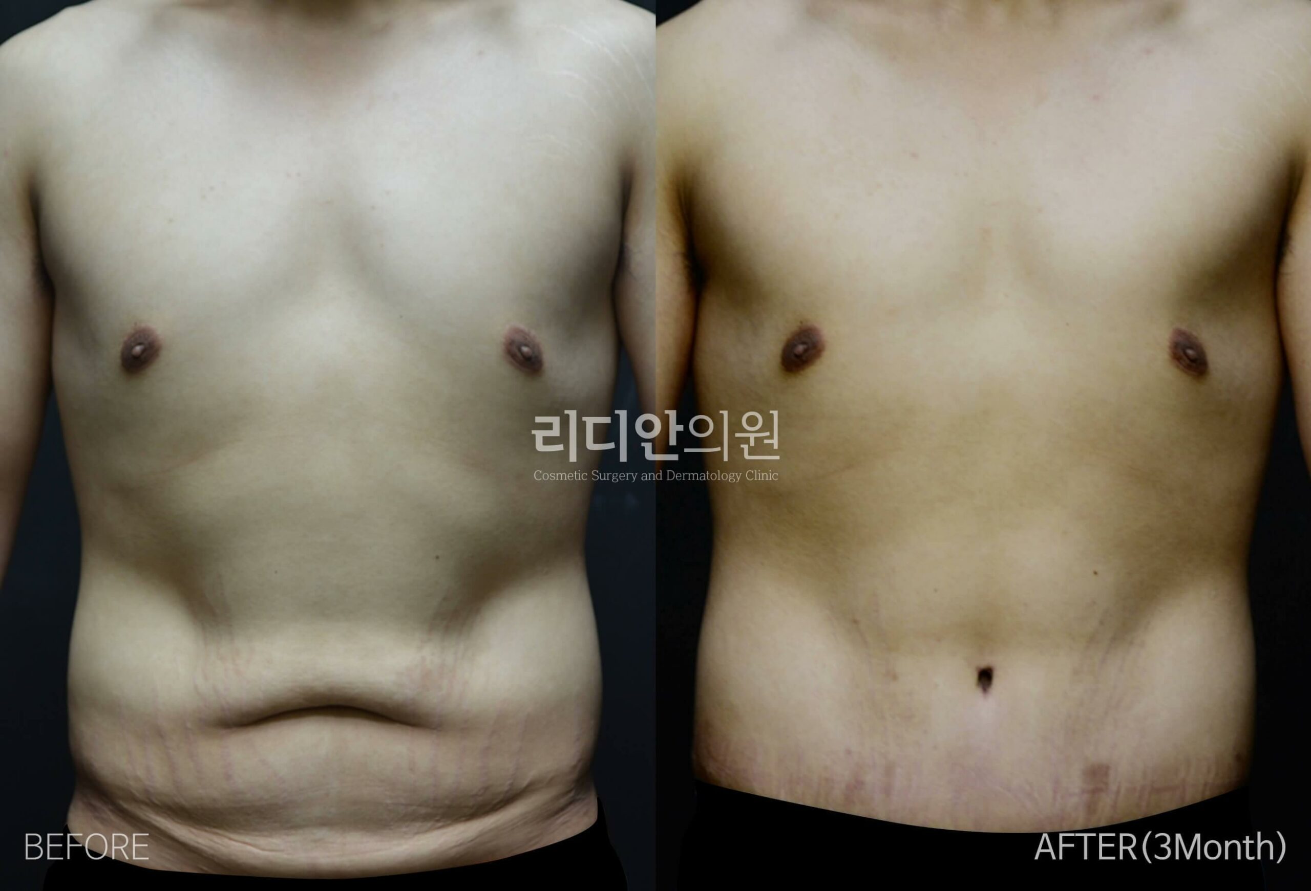 tummy tuck korea before after pictures
