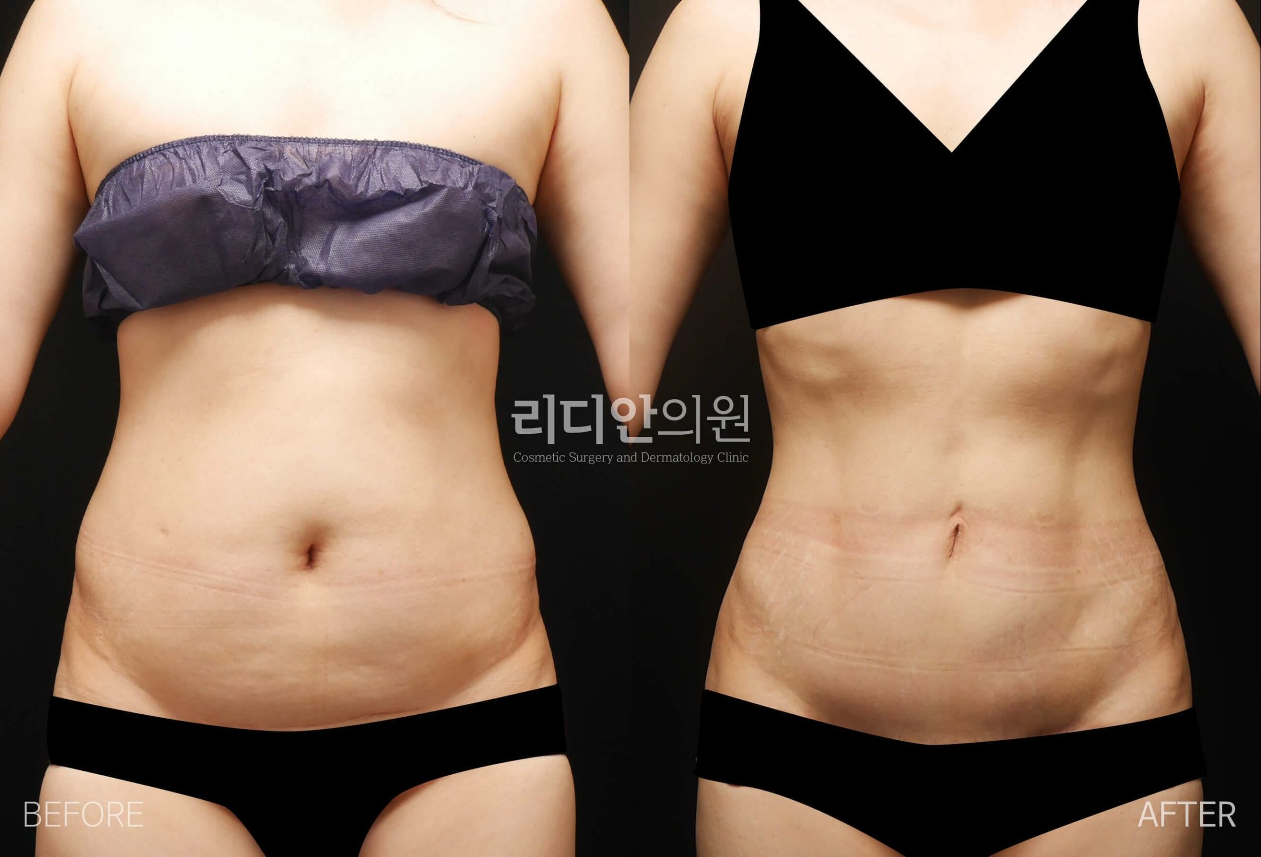 tummy tuck korea before after pictures