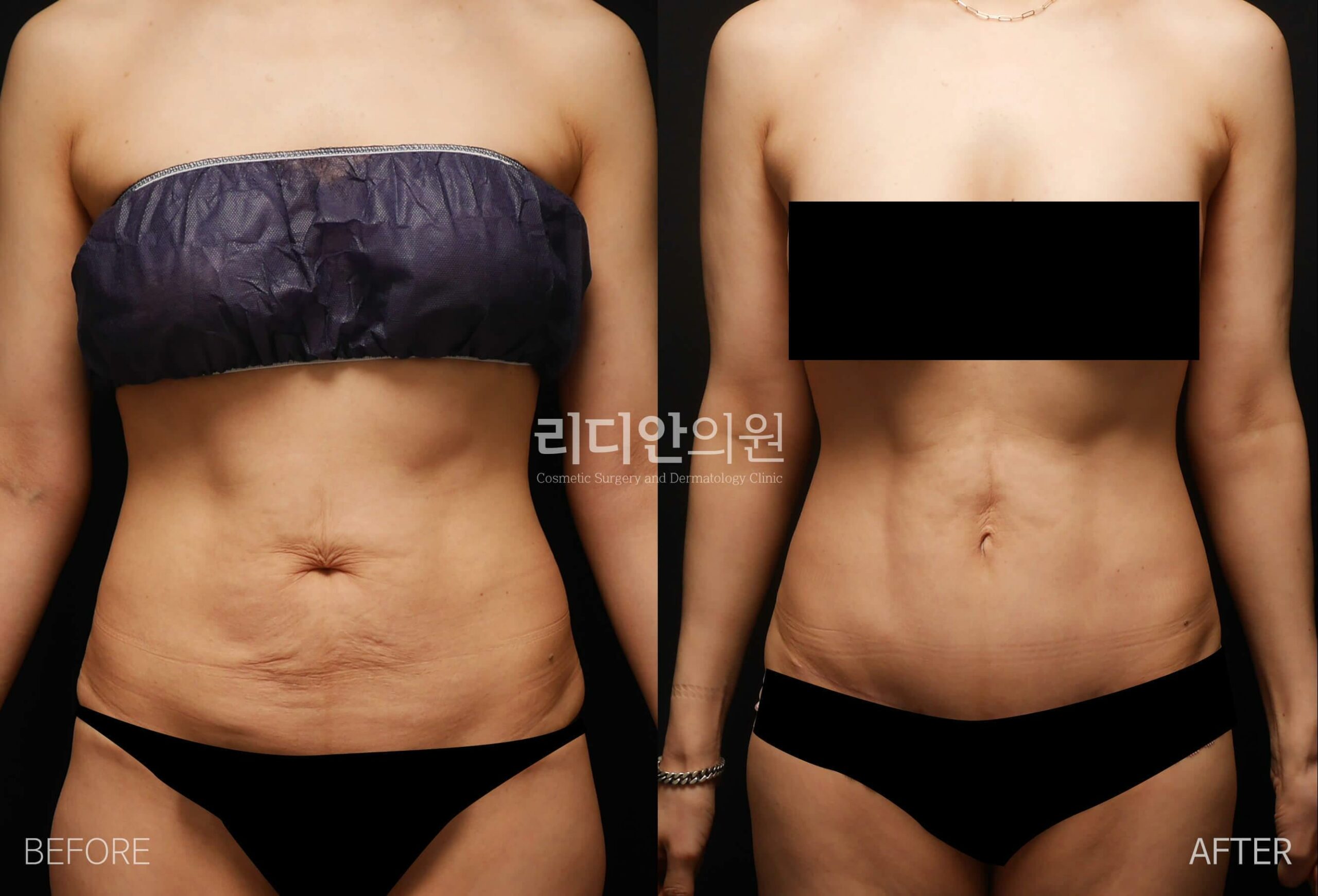 tummy tuck korea before after pictures