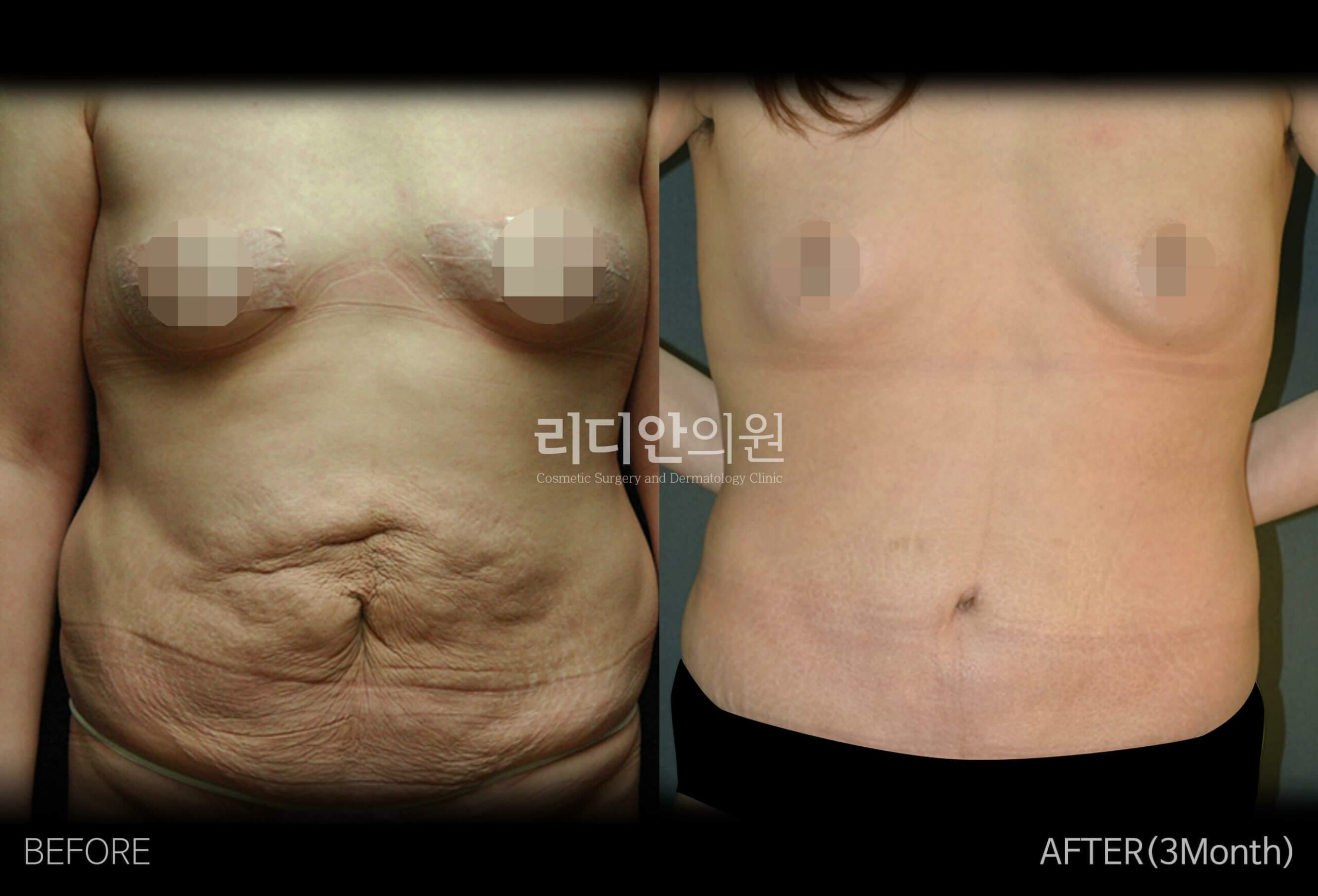tummy tuck korea before after pictures